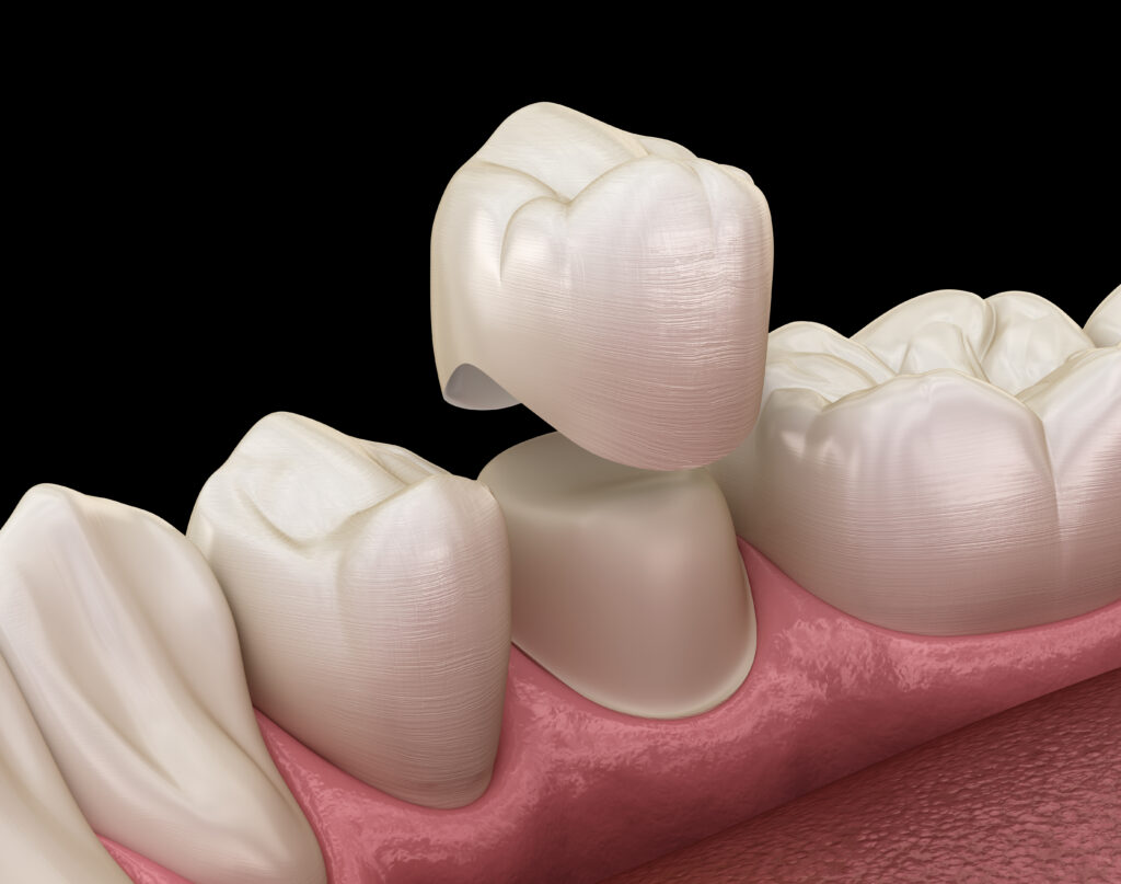 Dental Crowns Near Me in Kingman, AZ - Expert Care and Advanced Technology