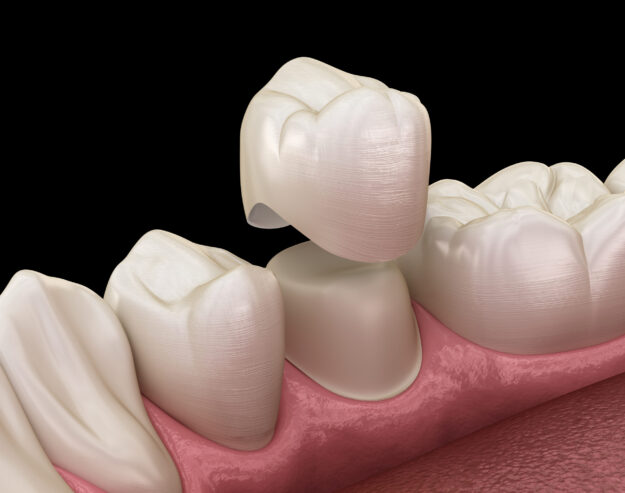 Dental crown premolar tooth assembly process. Medically accurate Dental Crowns Near Me in Kingman, AZ - Expert Care and Advanced Technology