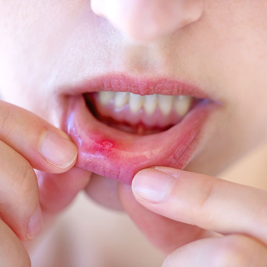 canker sore 2025 543