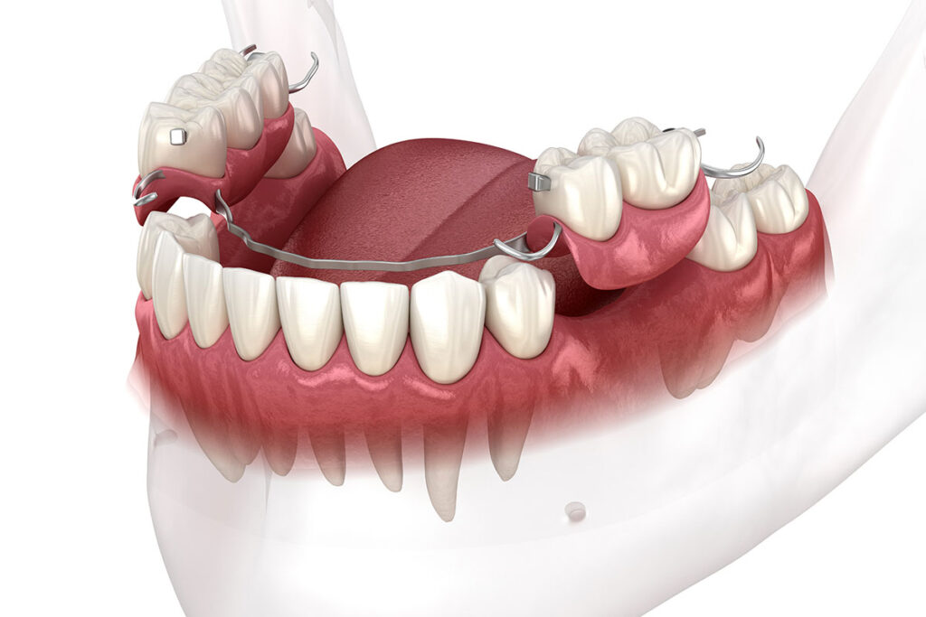 flippers removable partial dentures
