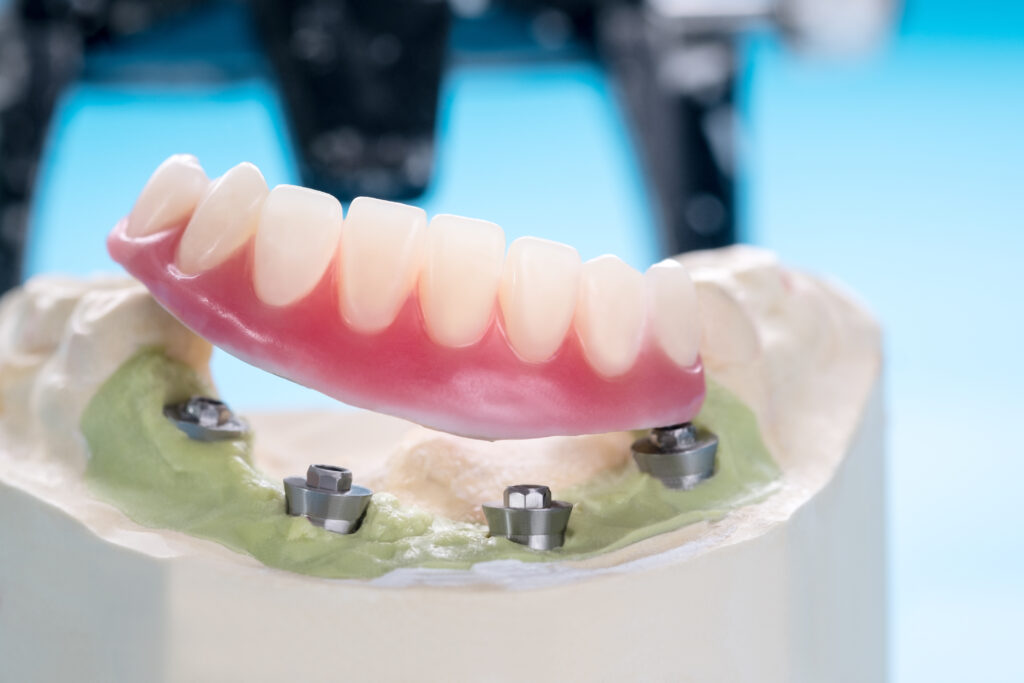 implant retained partials